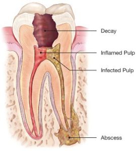 Infected tooth 270x300 1