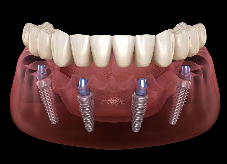 Best all on 4 dental implants