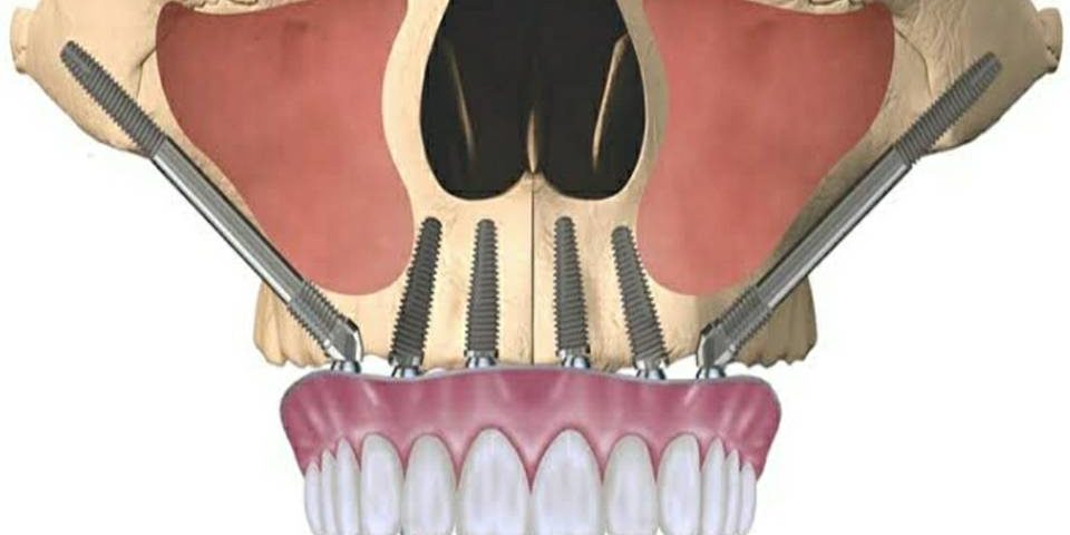 Zygoma implants at dental trust