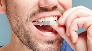 Best Clear aligners in Mira Road