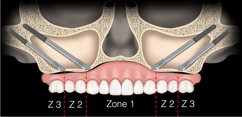 dental trust implant treatment