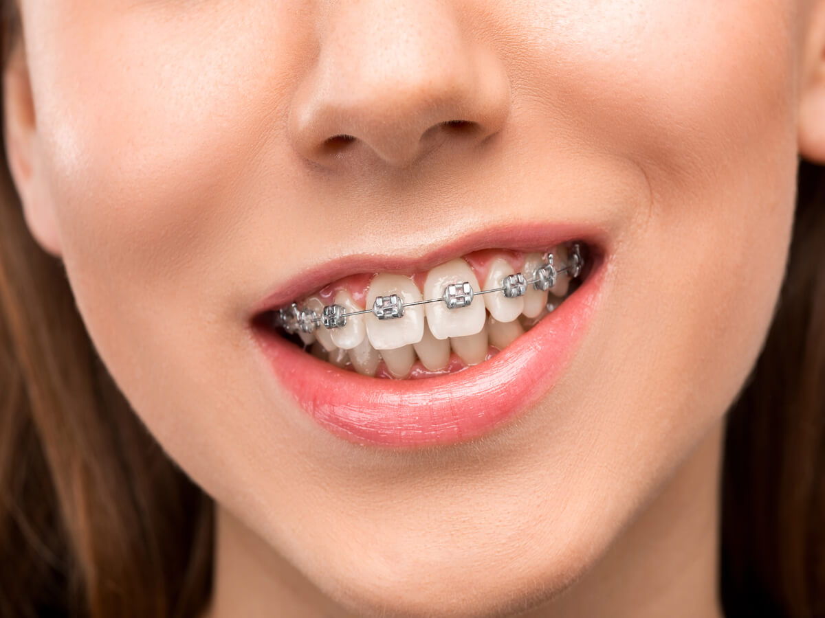 Best Metal Braces