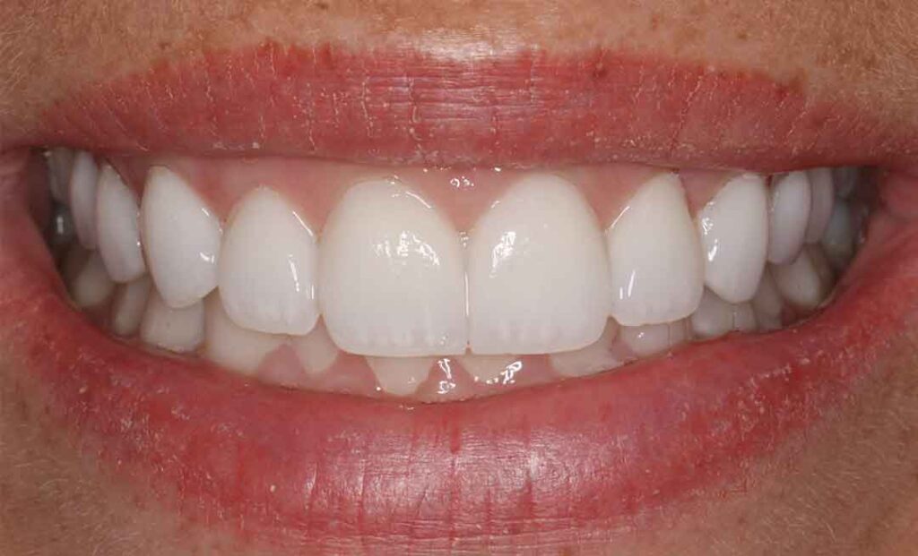 gum treatment