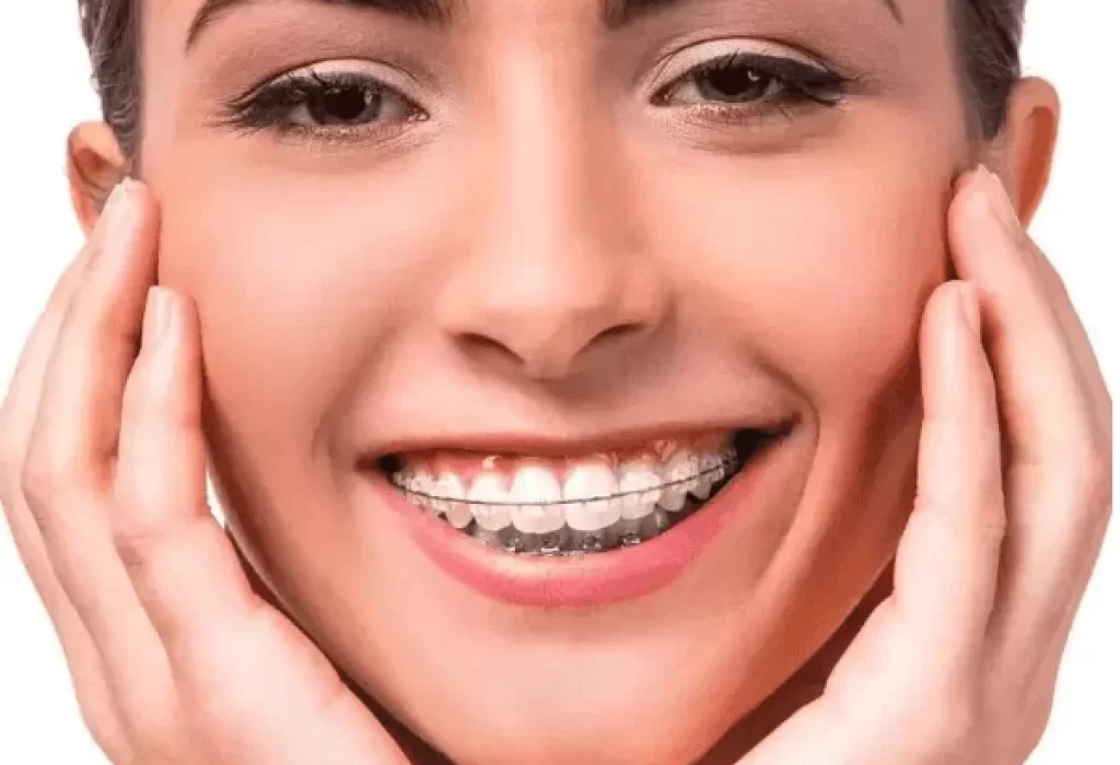 ceramic braces at dental trsut