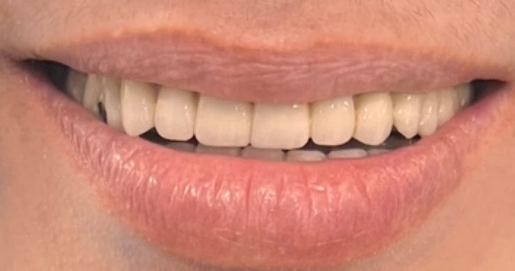 hollywood smile makeover by DT 2