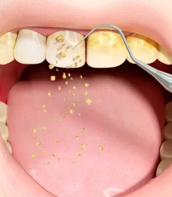 scaling teeth trust